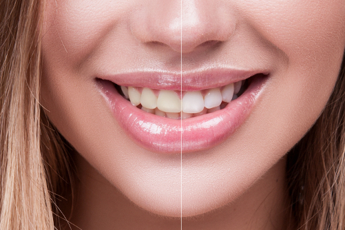 Smile Makeover Secrets: How Porcelain Veneers Can Transform Your Look