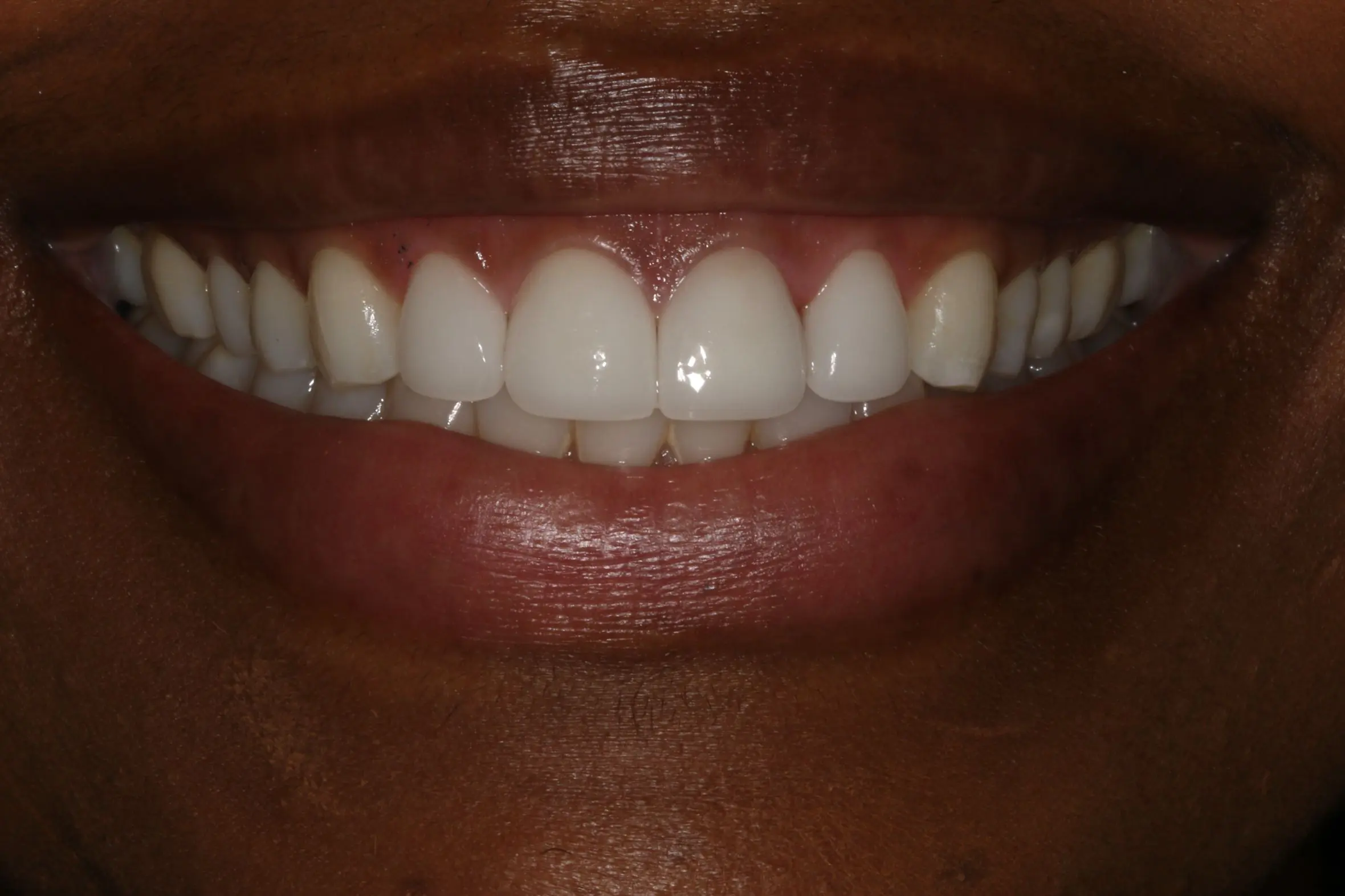 After Prepless Veneers