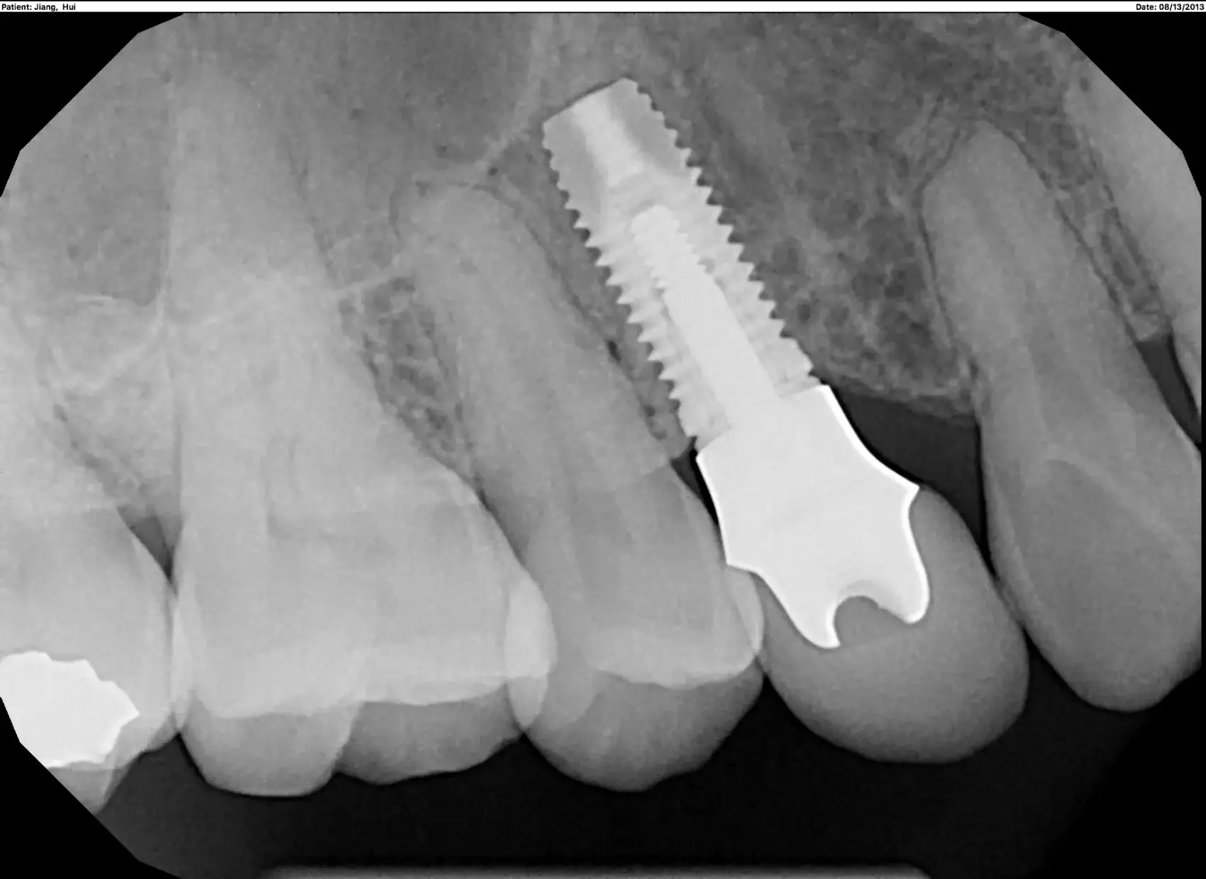 Dental Implant near me Washington DC